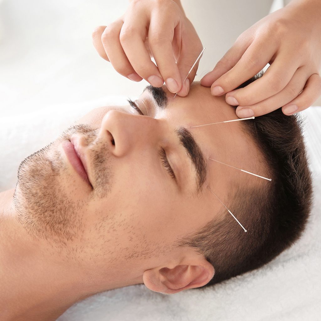 akupunktur1